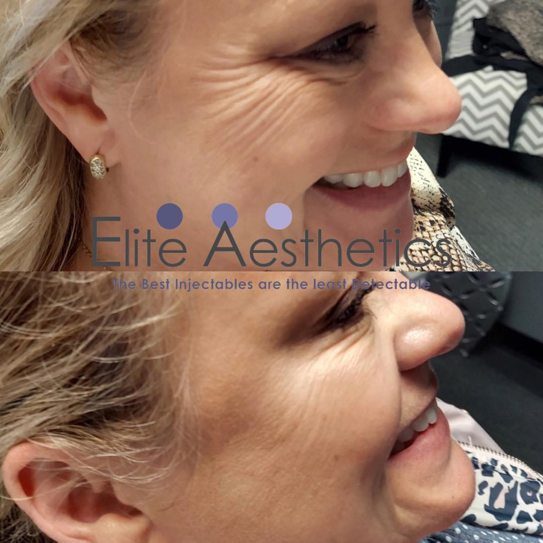 Coolsculpting Overland Park Kansas